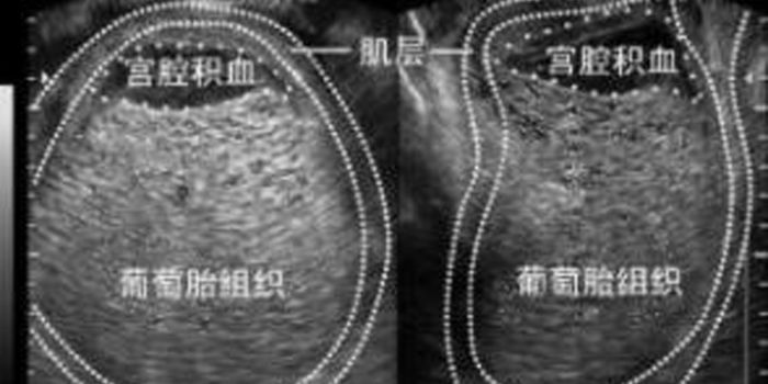 葡萄胎是什么原因引起的 形成原因及预防 www.91yuer.com